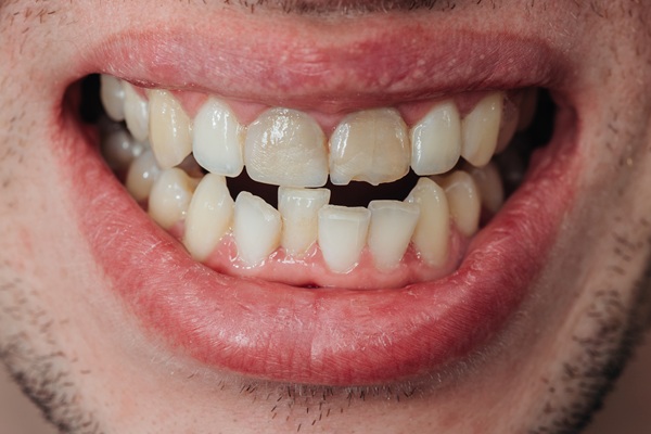 How Important Is It To Get Dental Care For A Chipped Tooth?